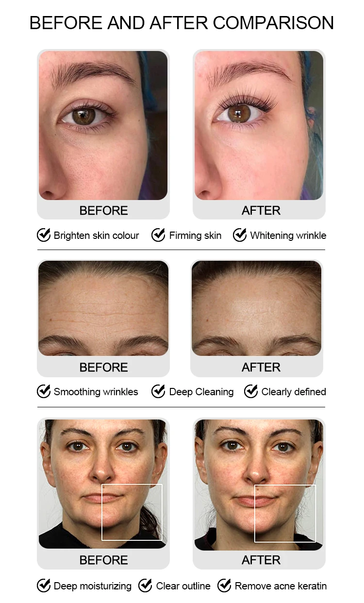 microdermabrasion hydro diamond micro dermabrasion machine for beauty salone