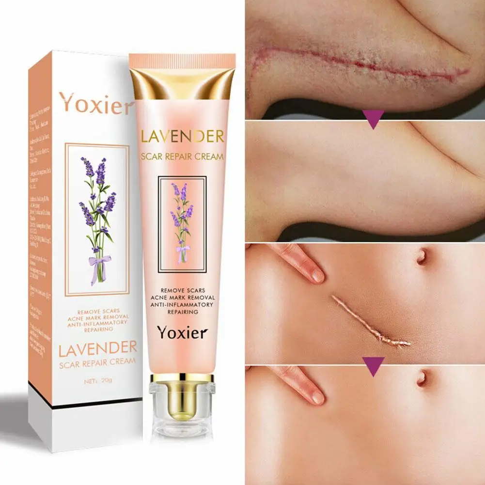 tik tok hot acne scar removal cream Removing Burn Scars old scar and dark spot on leg remover cream