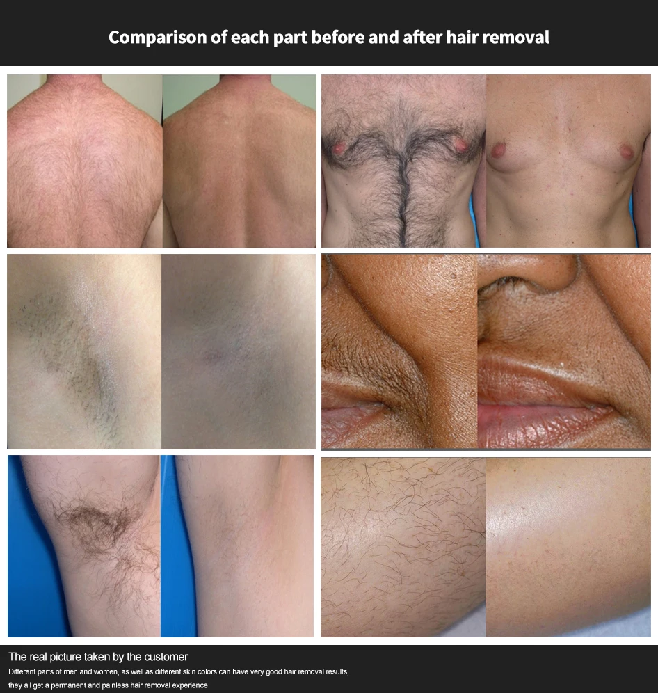 2023 Newst 808nm Diode Laser Hair Removal 755 808 1064 Diode Diodo Laser Hair Removal Equipment