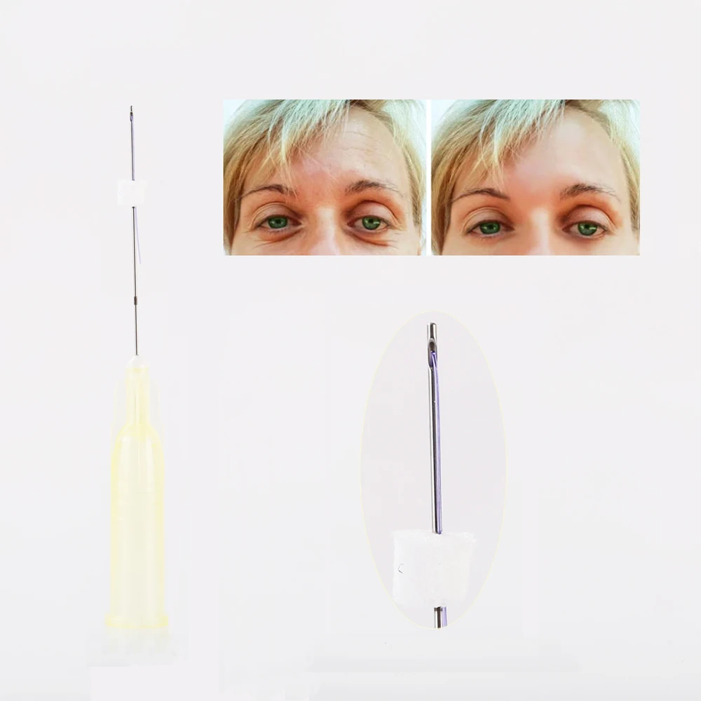 Лидер продаж, 30 г, 25 мм, тупые канюли, ПДО резьба, подъем под глазами