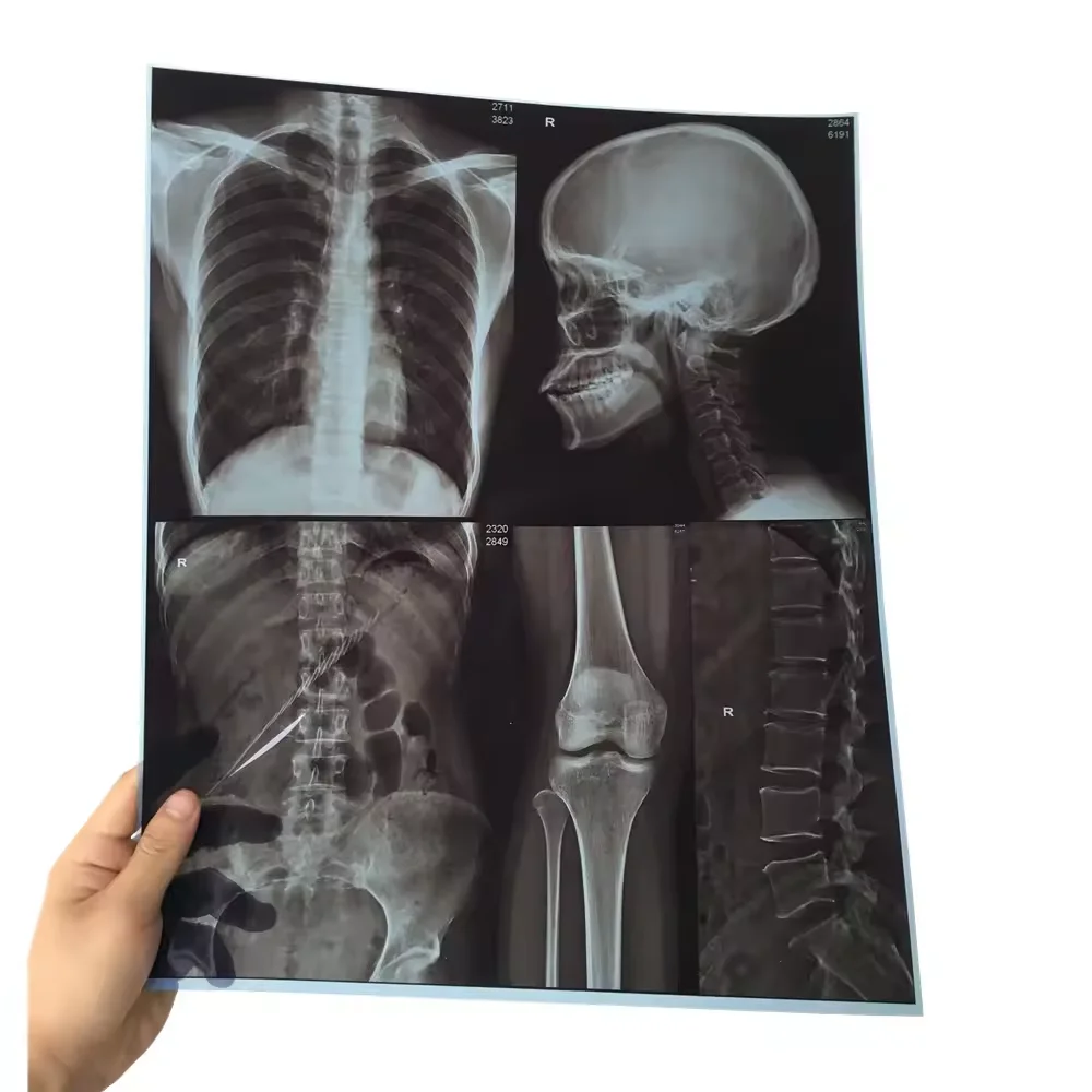 Medical jumbo blue film flat panel detector x-ray film