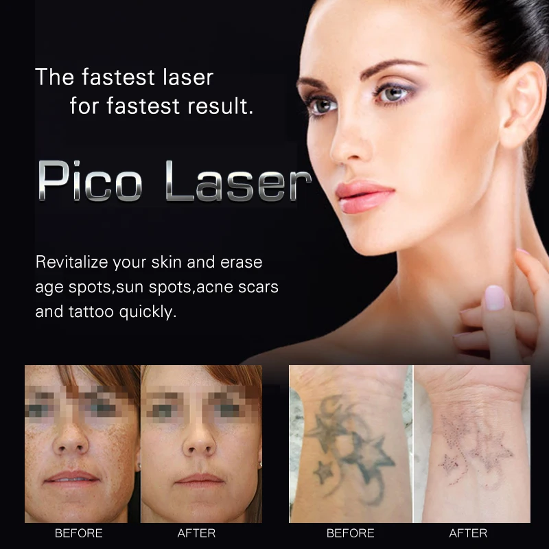 Лазерное Оборудование Для Удаления Татуировок IPL Winkonlaser 1-2000Mj 600-750Ps Picosecond Laser