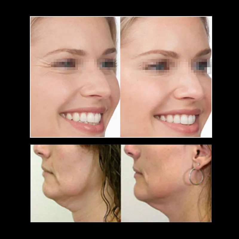 
3d mesh remove neck folds multi pdo thread needle with pdo thread lift with needle for beauty 