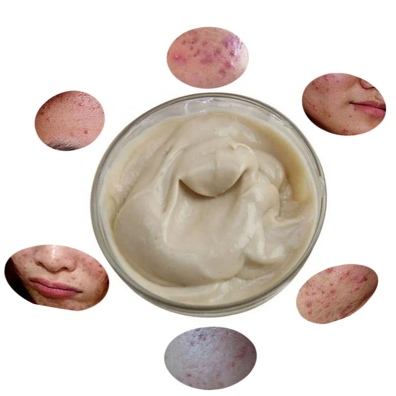 1kg Herbal Acne Treatment Acne Removal Cream Repair Face Skin