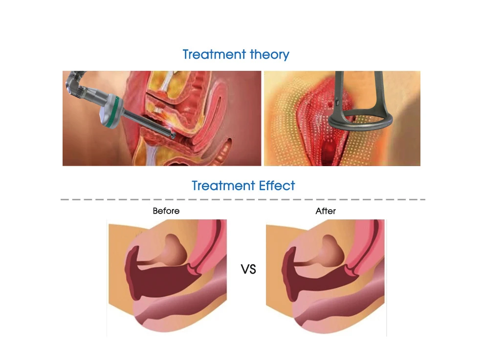 Seek Agents! Glass/RF Tube 70W Fractional vaginal co2 laser Tightening Beauty Equipment Sale Portable Co2 fractional co2 laser