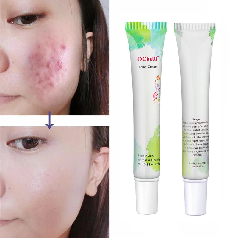 Лучший натуральный органический продукт для ухода за кожей с витамином Е Удаление прыщей лечение шрамов от акне оптовая продажа крем