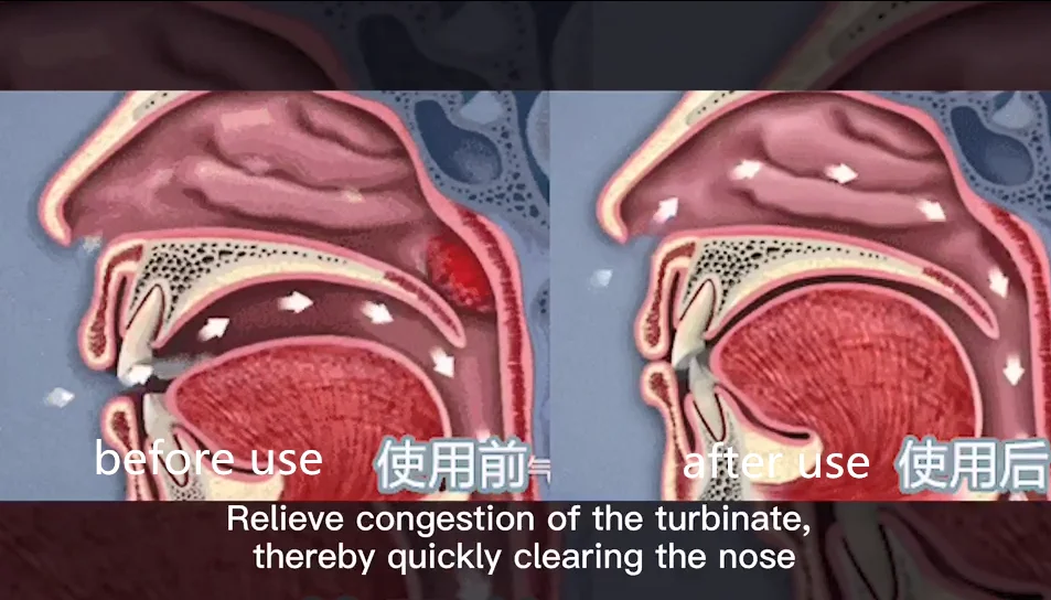 Small Size Portable Cold Red Light Treatment Allergy Rhinitis Nasal Irradiation Equipment With Long-term Use