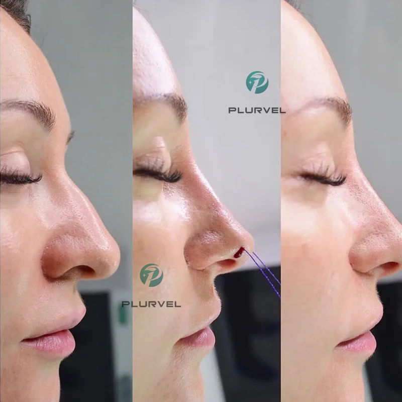 2023 Korea lift pdo pcl threads lift molding cog for skin tightening nose cog thread