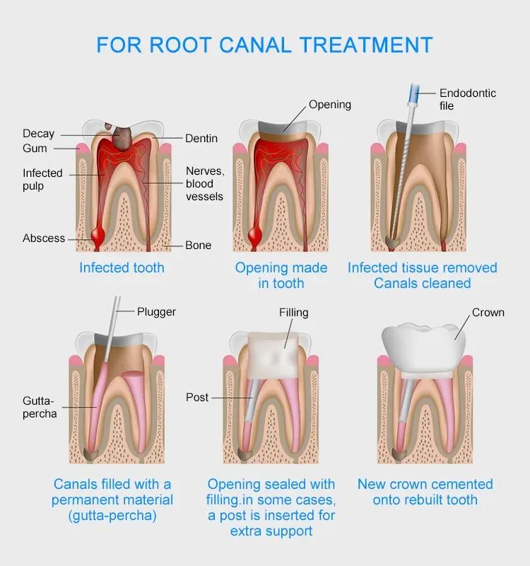 High Quality 02/04/06  taper gutta percha points with cheap price