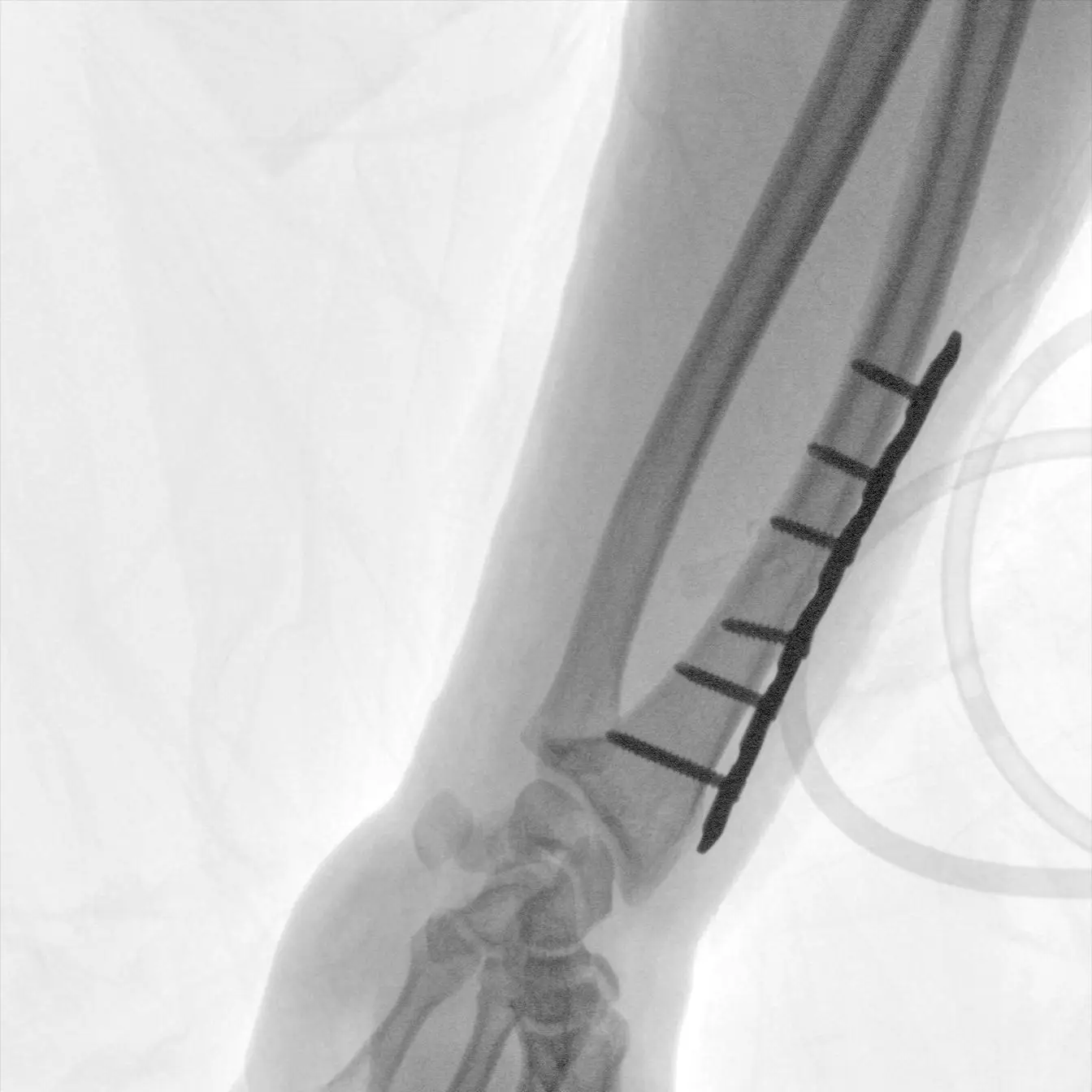 X-ray C-arm machine PLX118F what is c arm x ray machine