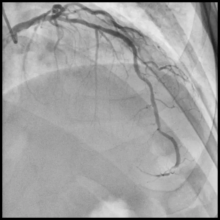 CE Approved 7 Axis Floor-Mounted C arm X-Ray Angiography Machine for cardiac intervention