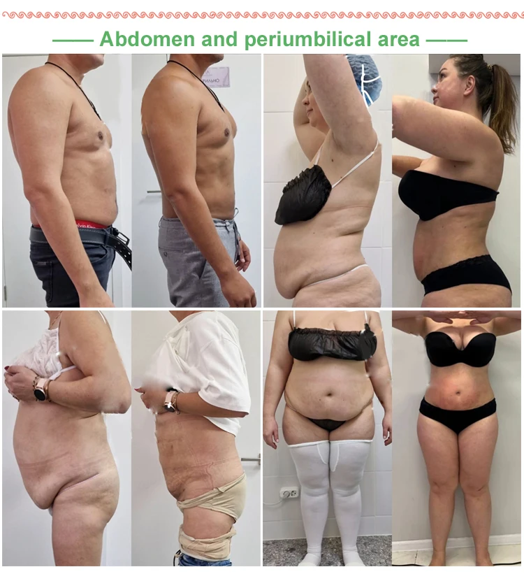 Endolaser 1470nm Face Lifting Skin Rejuvenation Fiberlift Laser Liposuction Machine