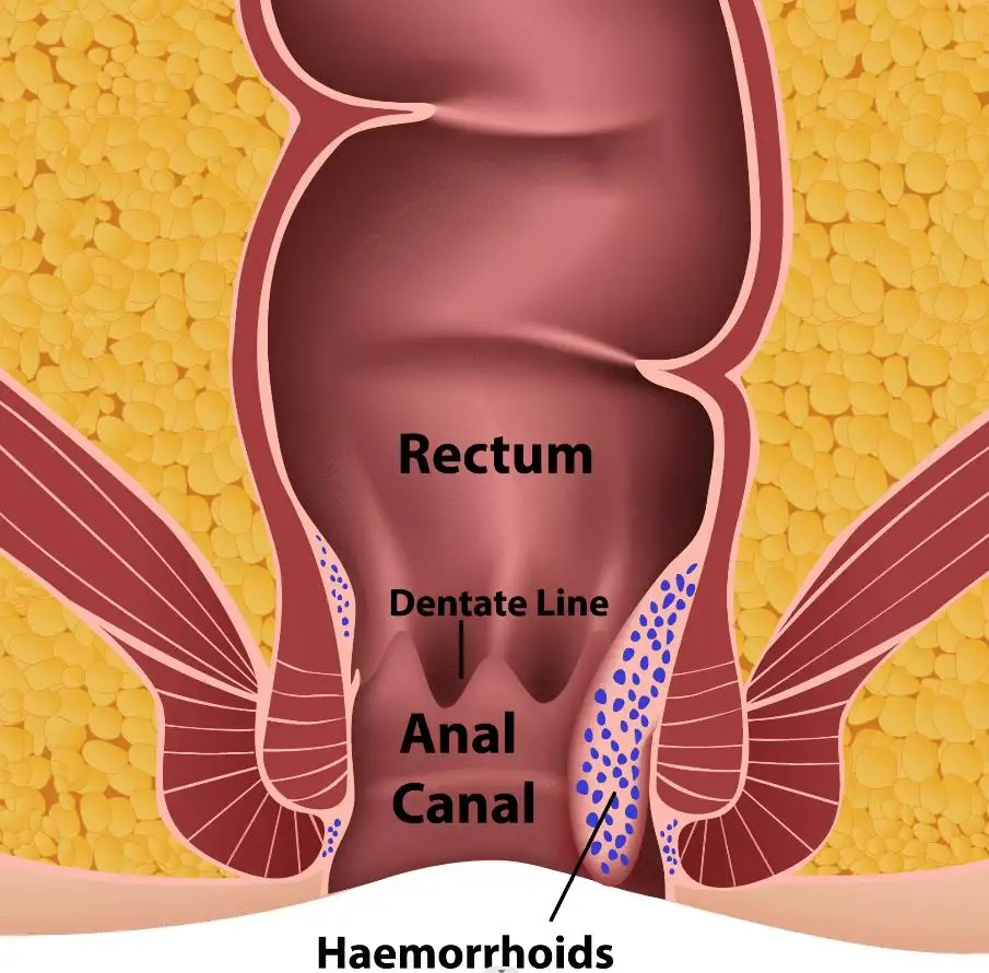 980nm 1470nm anal manometry laser proctology laser for hemorrhoids
