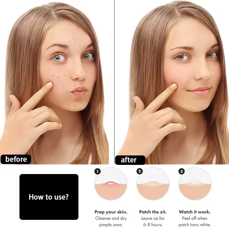 Oem Wholesale Private Label Miracle Acne Pimple Patch Spot Cover Facial Stickers Treatment Hydrocolloid Acne Pimple Patch