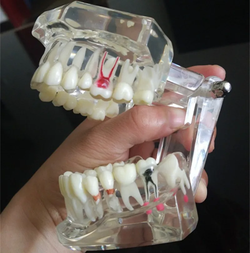 teeth can be removable dental activity pathological model teeth model