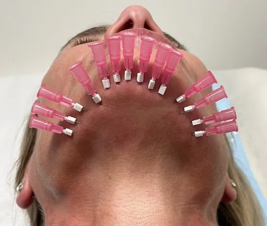 baby face pcl polylactic acid 30G  38mm mono threads south korea facial threads