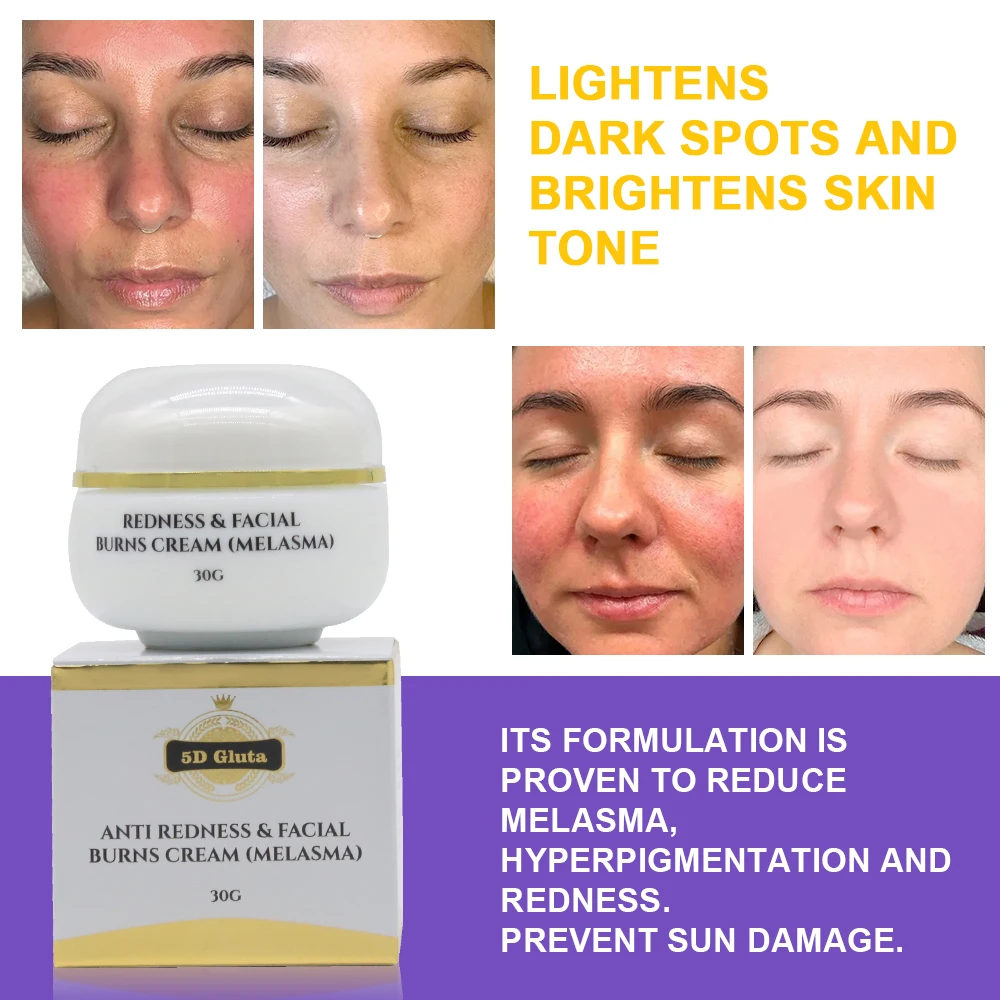 Strong Effective Skin Lightening Reduce Redness Burn Face Face Whitening Freckle Cream Remove Melasma Fade Dark