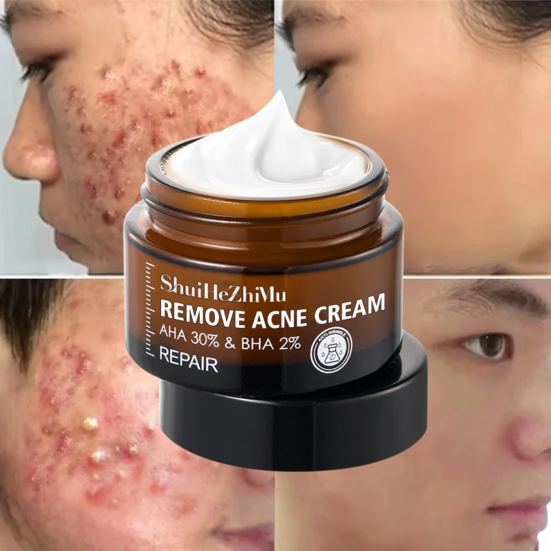 Lighten Acne Cream Acne Scar Spots Cream Skincare Control Shrink Pores Whitening Moisturizing Anti-Acne Face Cream