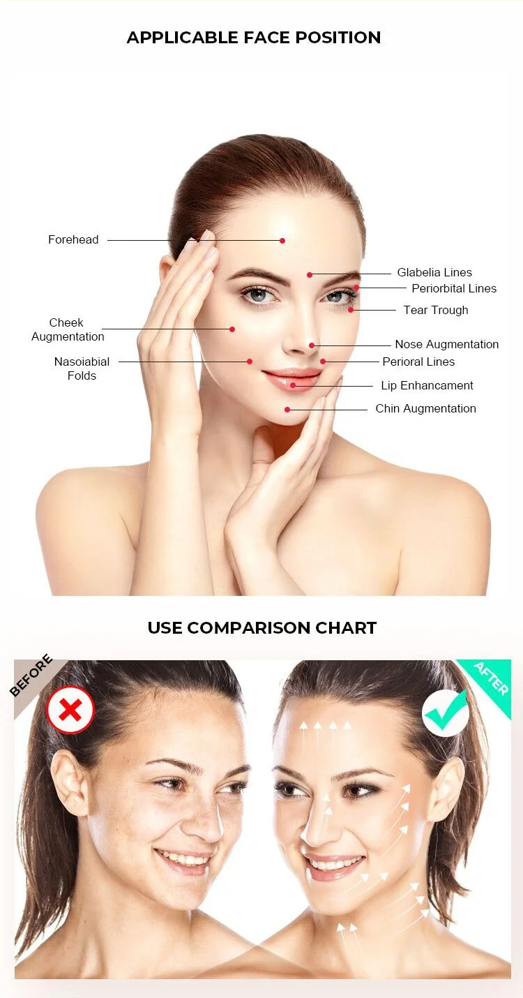 Heremefill  Collagen Face Skin Lifting Suture Needle Pdo Faden Cog Barbs Rose Contour Thread 4d With W Canula