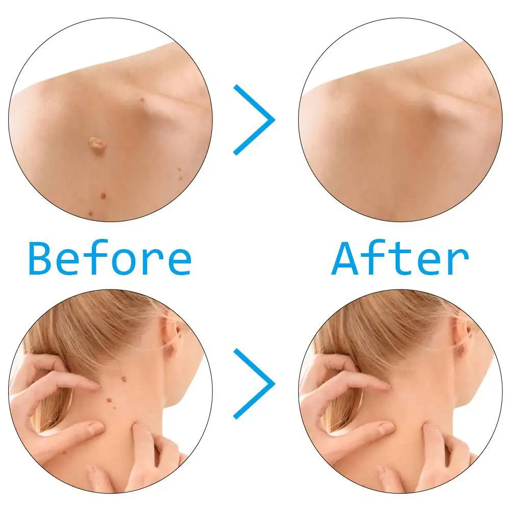  Blue Set Skin Tag Removal Kit Home Use Mole Wart Remover Equipment Micro Treatment Tool Easy To Clean