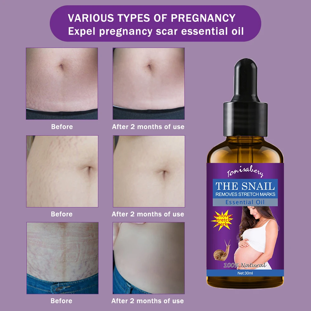 
Stretch Marks Remover Oil Skin Care Treatment Cream For Stretch Mark Removal Maternity Slackline For Pregnant Oils 30g 