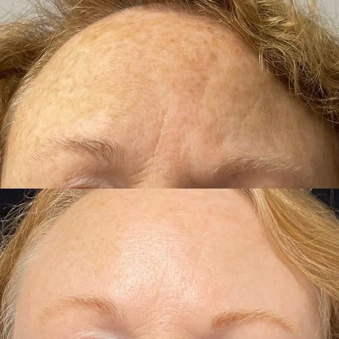 Портативная фракционная машина для удаления шрамов от