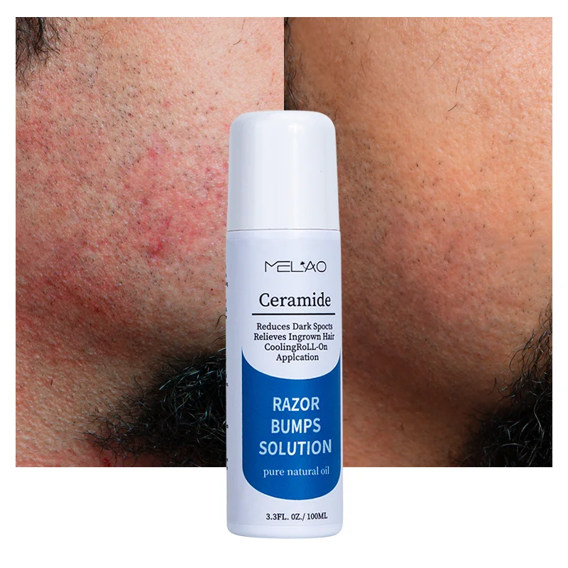 Razor Bump Serum Roll On Stick After Shave Redness Razor Bump Remover Stopper For Women Men