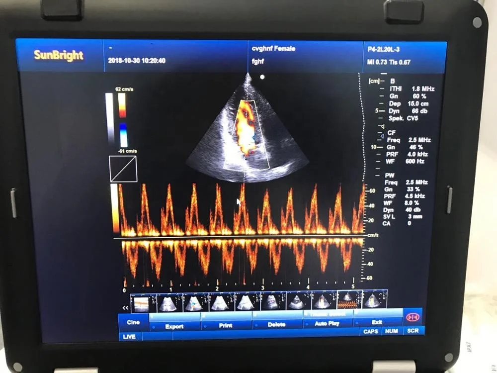 New design for sale Color doppler cheap price ultrasound scan machine sun 906b
