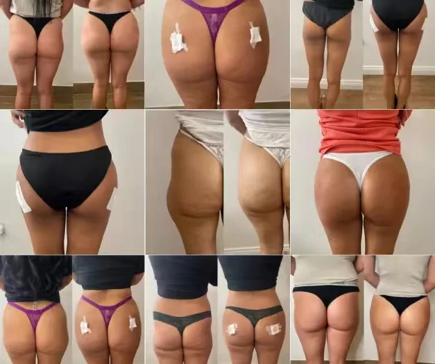 Heremefill Butt Enhancing Injections Buttock Enlarge Hyaluronic Acid Filler Injection 20ml