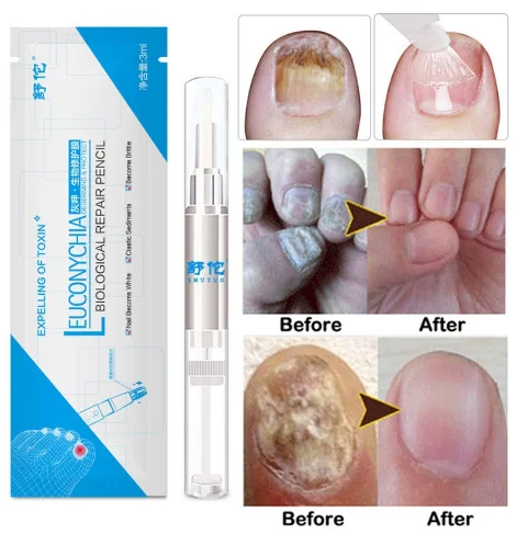 Nail Fungus Repair Treatment Pen Products Onychomycosis Paronychia Anti Fungal Nail Infection Chinese Herbal Care Oil Pen