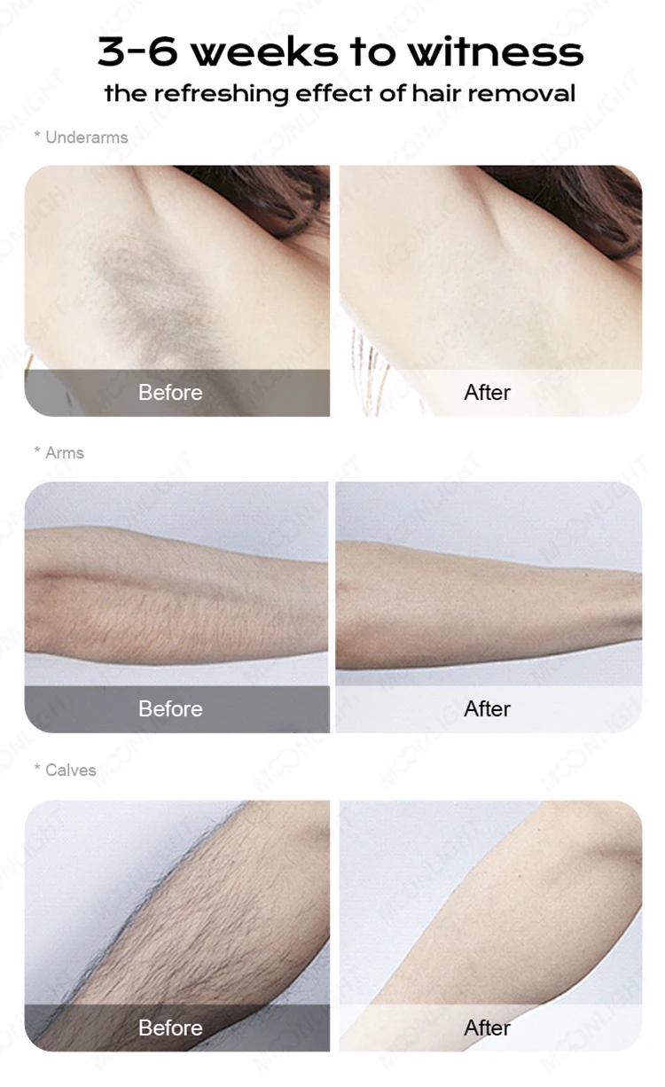 professional laser diode 3 waves portable epilator diodo laser hair removal handset machine device