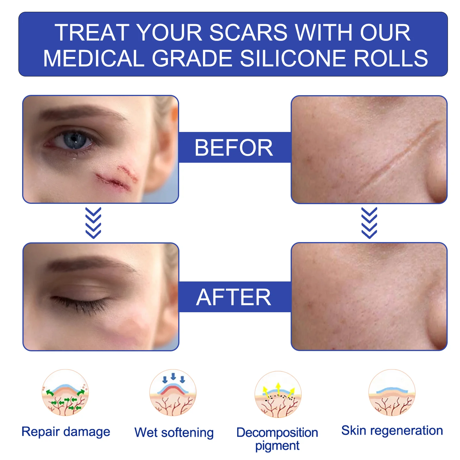 Custom Logo Clear Silicone Scar Removal Patch Skin Care Acne Scar Removal Treatment Medical Silicone Scar Sheets