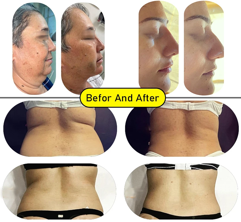 Fat dissolving  980nm lipolysis diode laser machine for sale slimming  lipolysis for commercial  diodo endolaser 980 nm 1470