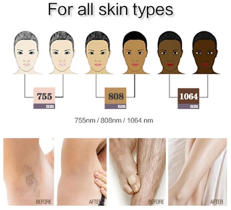 HUAMEI stationary 808nm diode hair removal laser Permanent hair removal machine laser diode hear remover