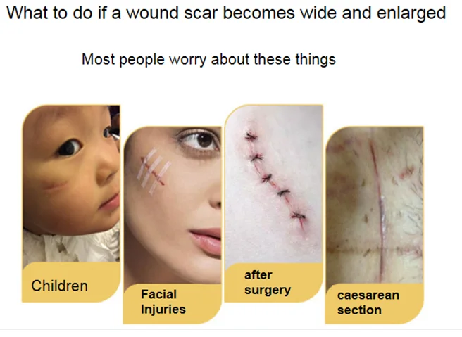 Chinmed Medical Supplies Wound Skin Closure Steri-strip Reinforced Adhesive Wound Closure Strip