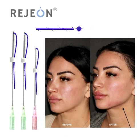 Beauty Ultra V Lift 18g 100mm Blunt W Thread Fios De Wires Lift Barbed Threads Cog 4d Pdo Lift