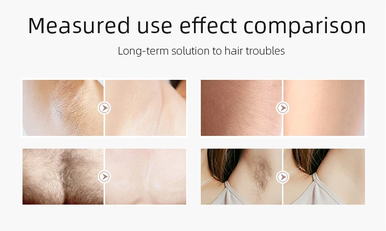 Diode Laser Permanent Painless Hair Removal Machine for Home Home Mini 3 Wavelength 755nm 808nm 1064nm Portable 2000W 11mm*11mm