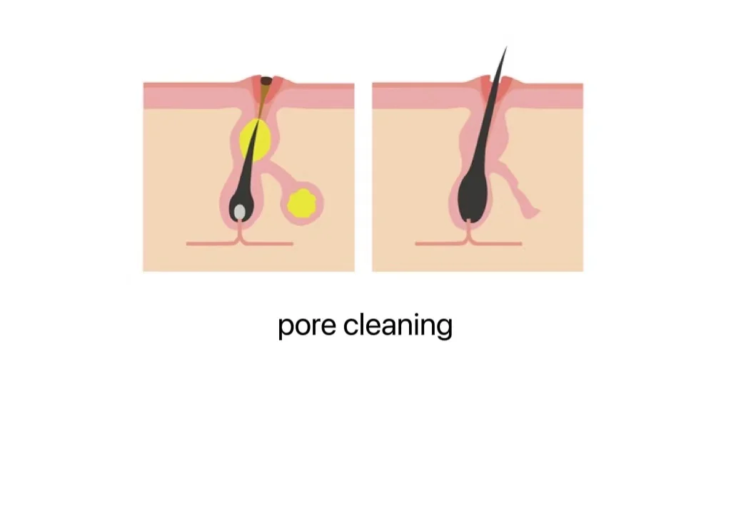 facial skin tightening