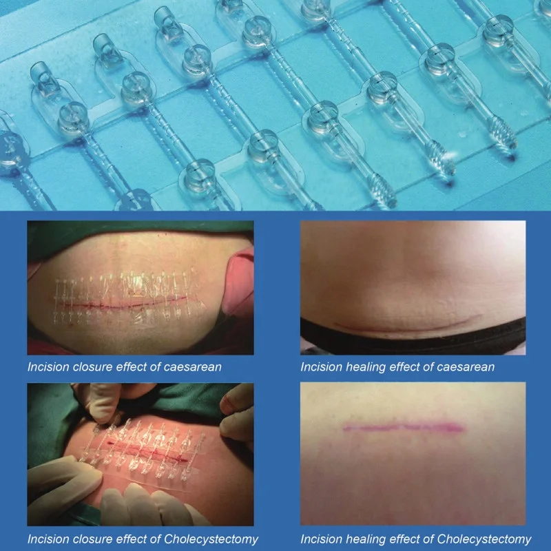 Suture Absorbable Different Types suture Nylon Monofilament Vicry Surgical medical suture