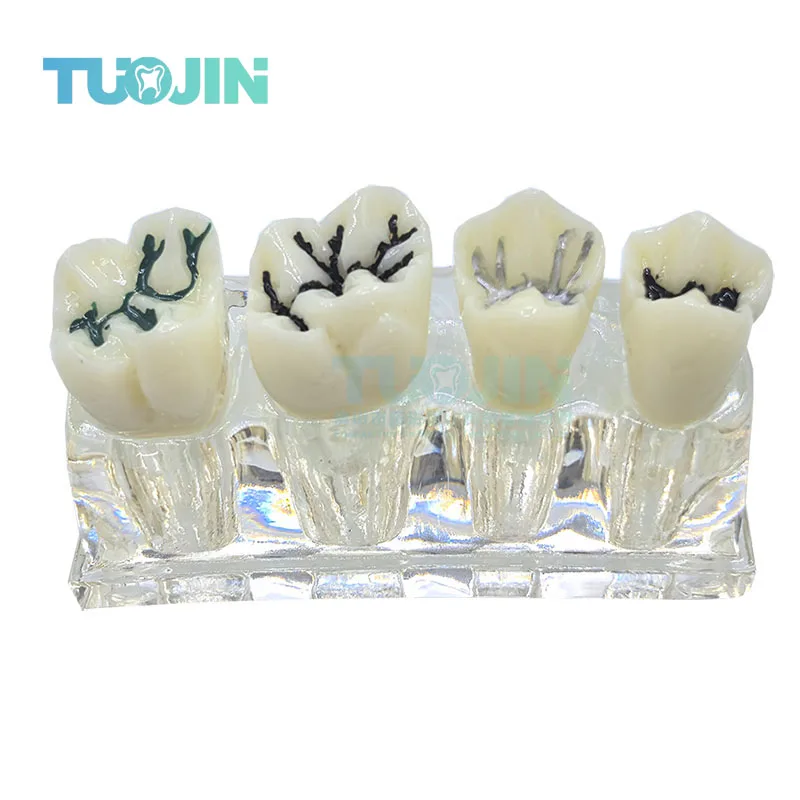 Transparent  Pit and Fissure Closure Model Early Dental Caries Model Student Learning Teaching Model