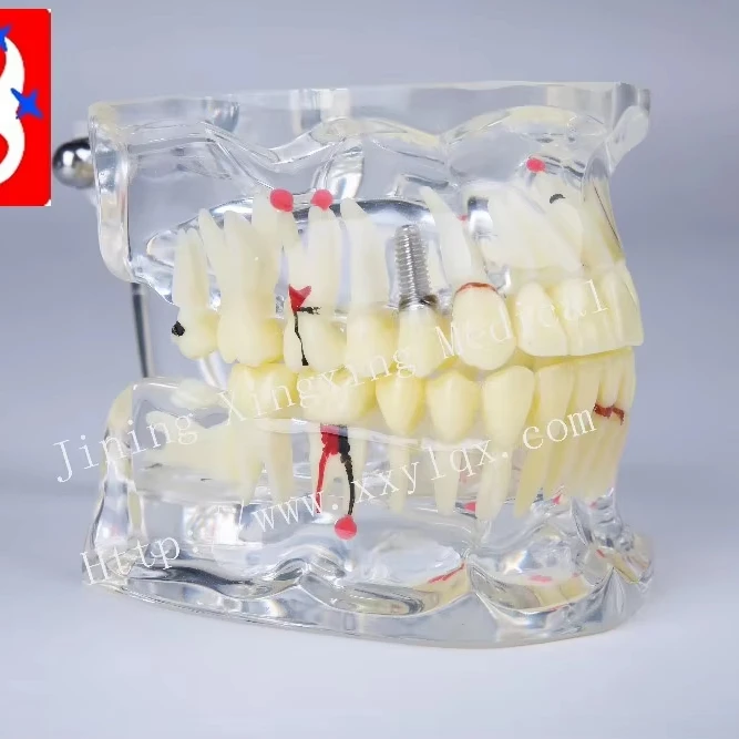 Adult pathological dental model with missing tooth caries apical cyst, tartar ,implant etc