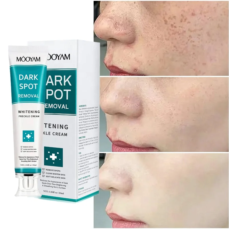 Customized Original Strong Anti Freckle Whitening Cream Powerful Removing Age Dark Spots Pigmentation Whitening Cream