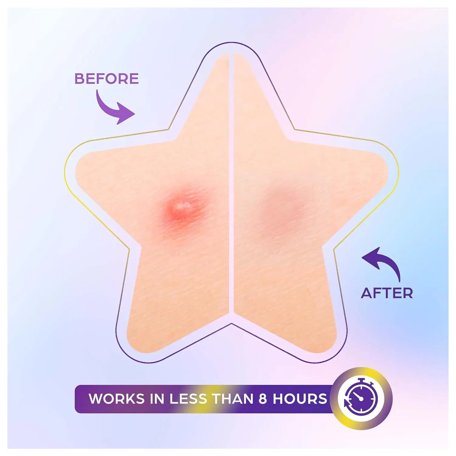 factory OEM hydrocolloid acne pimple patch zits blemishes whitehead remover fast cure acne patch star shape
