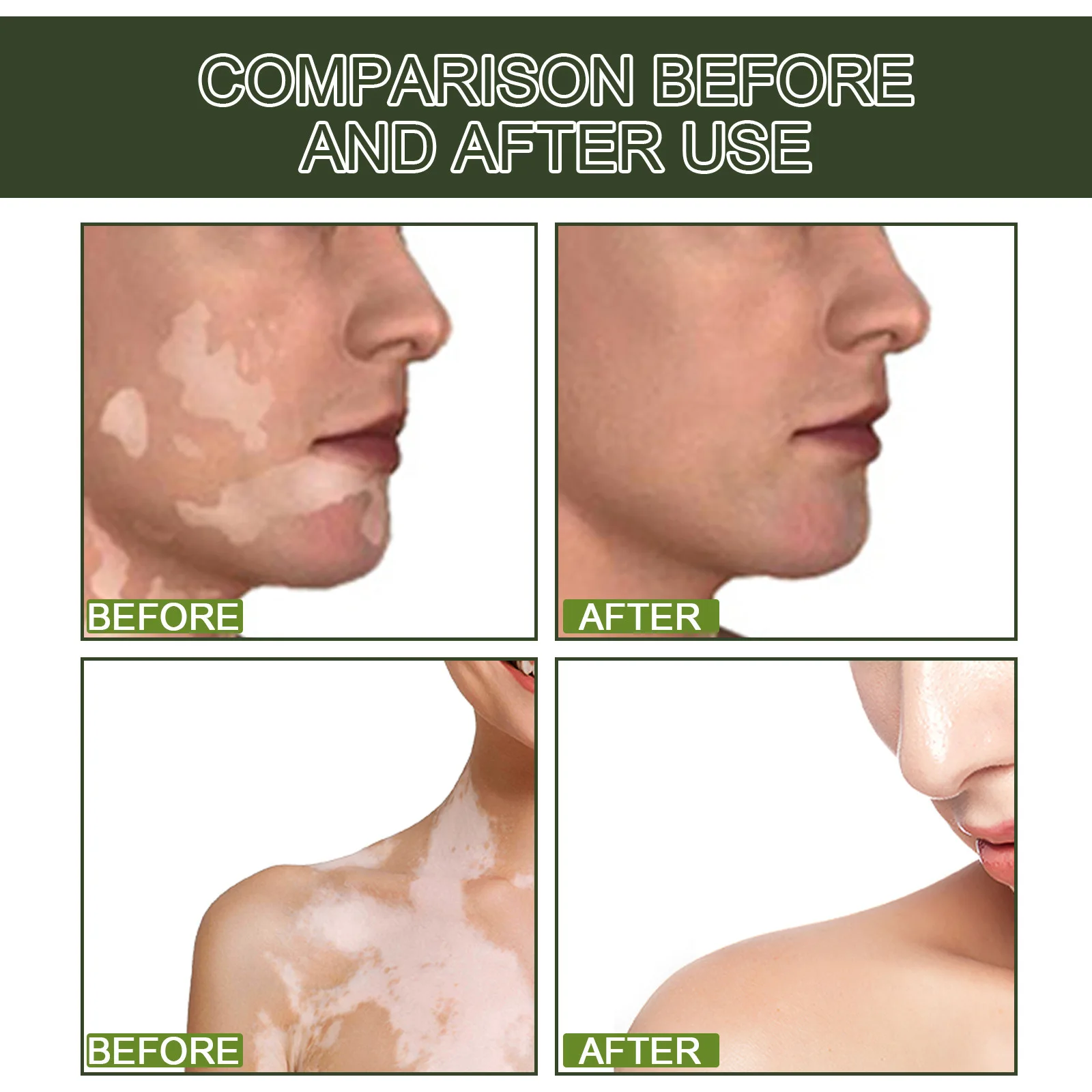 Popular plant extract EELHOE white spot removal anti bacterial liquid repair flecks sweat spots skin moisturizer care serum