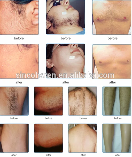 diode laser 808nm unichill hair removal machine 808 diode laser ice diode laser hair removal machine