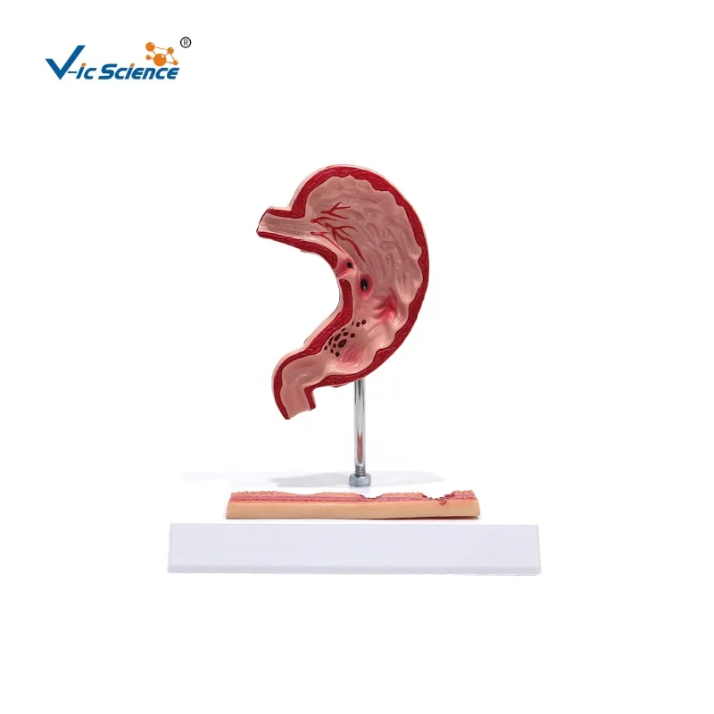 medical anatomical model Hot quality BN Plastic Stomach diseased  Gastric ulcer  anatomy model medical science education model