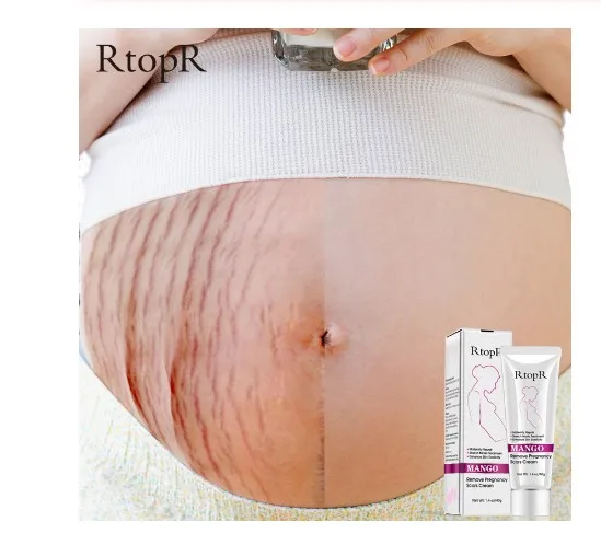 Mango Remove Pregnancy Scars Acne Cream Stretch Marks Treatment Maternity Repair Anti-Aging Anti Winkles Firming Body Cream