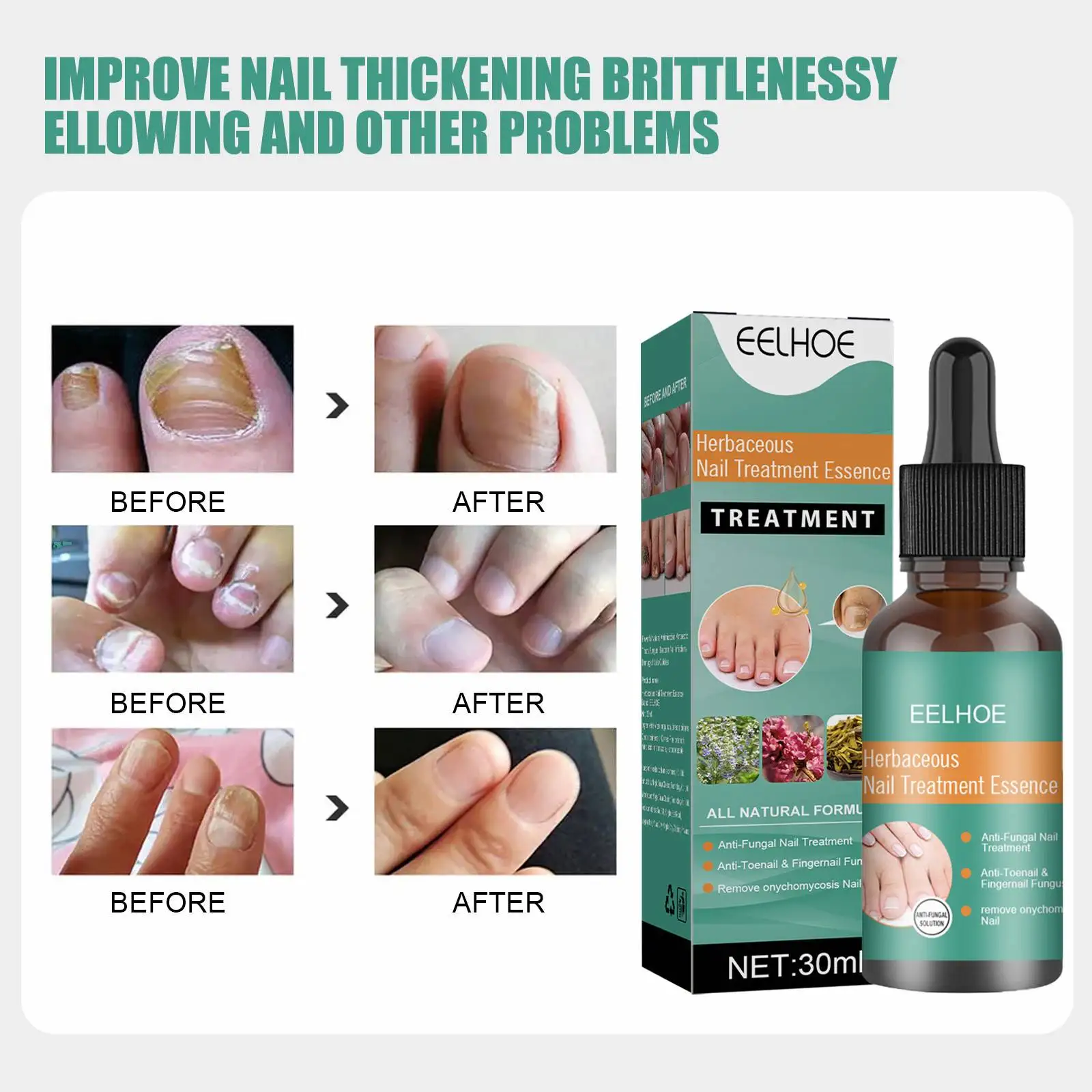 OEM ODM Nail Fungal Treatment Feet Care Essence Anti Infection Paronychia Onychomycosis Nail Foot Toe Nail Fungus Removal Liquid