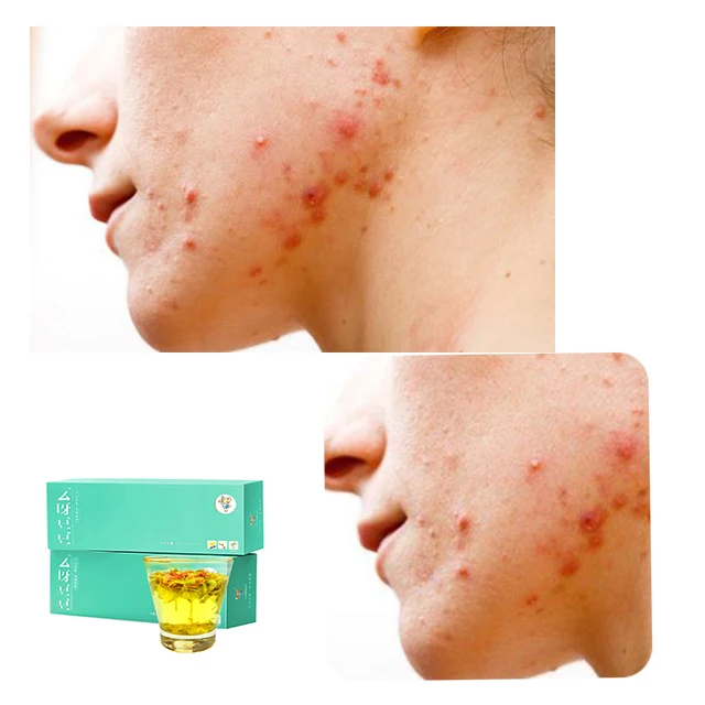 Natural Herbal Tea Anti-acne Smooth Skin Flavor Tea