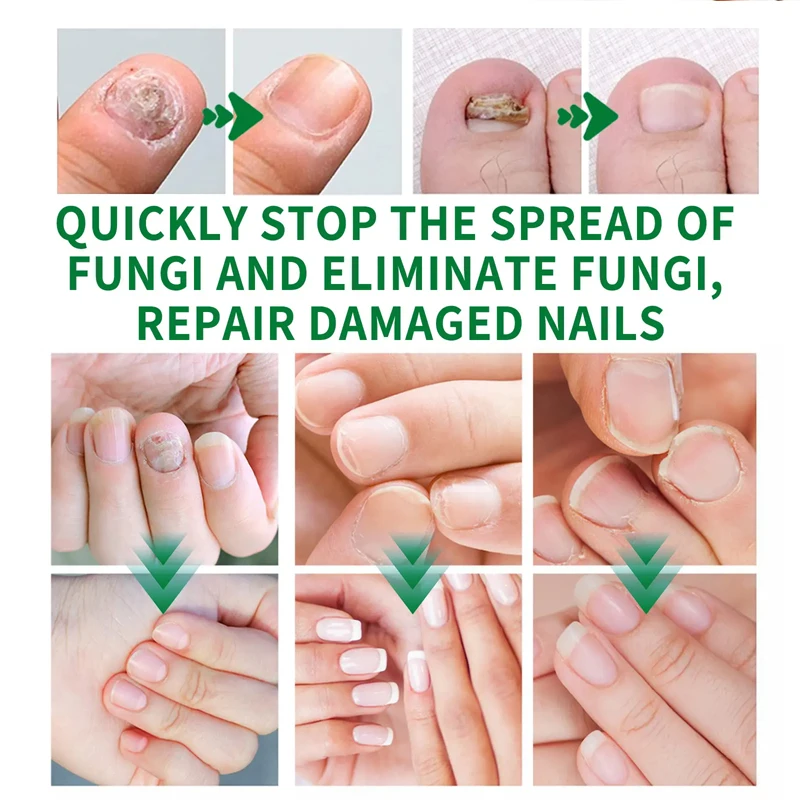 Private Label 7 Day Nail Fungus Treatment Essence Repair Bacteria Rough Nail Discoloration Brittle Nail Care Repair Essence